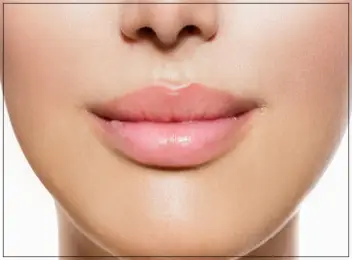 Close-up of lip enhancement results, featuring fuller, naturally contoured lips with a smooth finish.