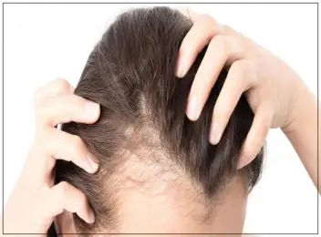 Close-up of PRF hair loss treatment, highlighting the natural process of stimulating hair growth and improving hair density.