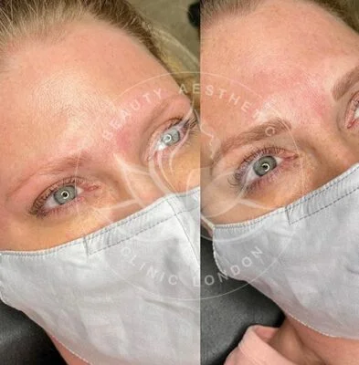 Detailed view of microblading eyebrows, highlighting the natural-looking, perfectly shaped brow strokes created with precision