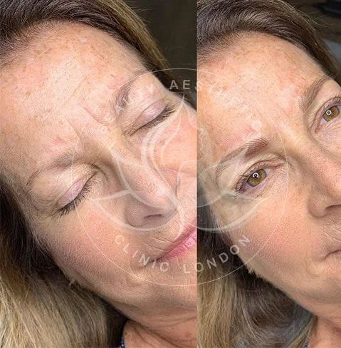 Detailed view of microblading eyebrows, highlighting the natural-looking, perfectly shaped brow strokes created with precision